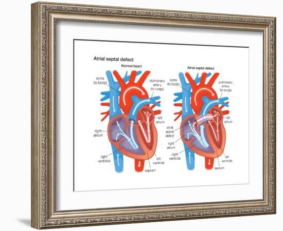 Atrial Septal Defect-Encyclopaedia Britannica-Framed Art Print