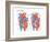 Atrial Septal Defect-Encyclopaedia Britannica-Framed Art Print