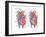 Atrial Septal Defect-Encyclopaedia Britannica-Framed Art Print