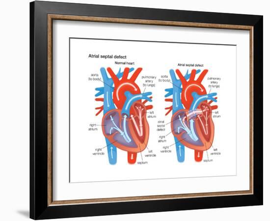 Atrial Septal Defect-Encyclopaedia Britannica-Framed Art Print