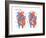 Atrial Septal Defect-Encyclopaedia Britannica-Framed Art Print