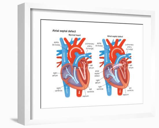 Atrial Septal Defect-Encyclopaedia Britannica-Framed Art Print