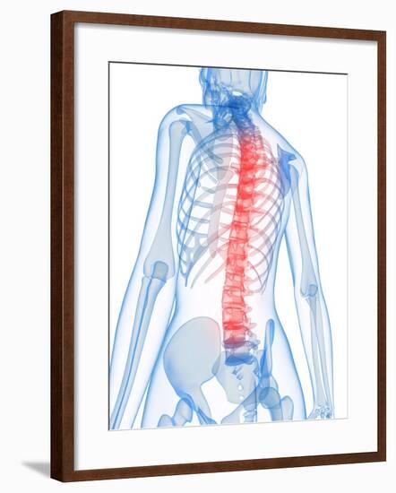 Back Pain, Conceptual Artwork-SCIEPRO-Framed Photographic Print