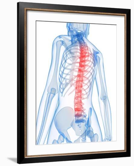 Back Pain, Conceptual Artwork-SCIEPRO-Framed Photographic Print