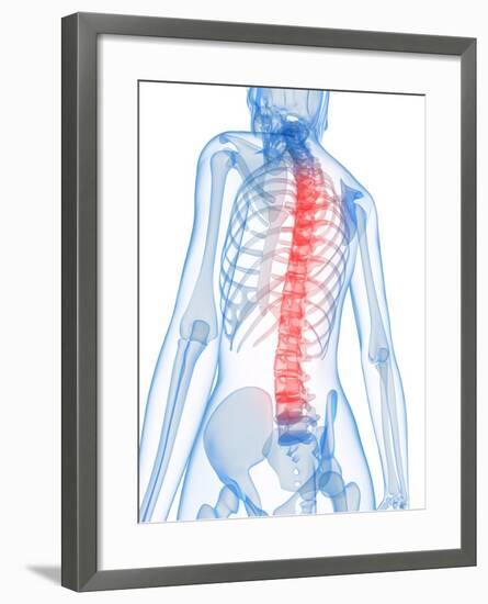 Back Pain, Conceptual Artwork-SCIEPRO-Framed Photographic Print