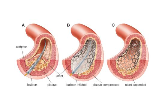 balloon angioplasty and stent insertion cardiovascular system