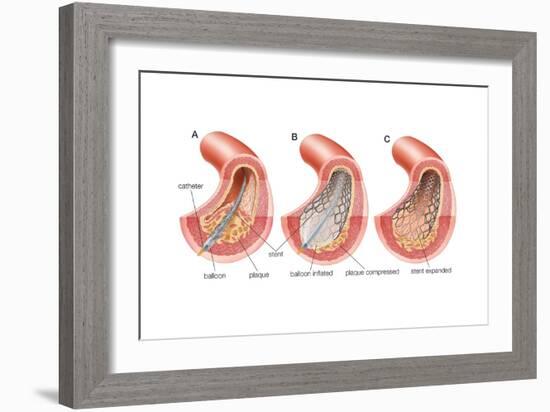 Balloon Angioplasty and Stent Insertion. Cardiovascular System, Health and Disease-Encyclopaedia Britannica-Framed Art Print