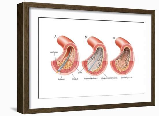 Balloon Angioplasty and Stent Insertion. Cardiovascular System, Health and Disease-Encyclopaedia Britannica-Framed Art Print