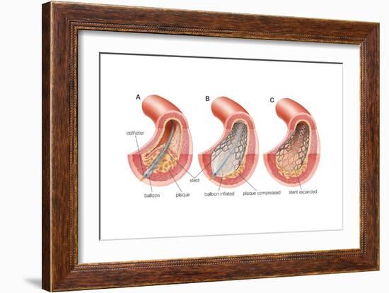 Balloon Angioplasty and Stent Insertion. Cardiovascular System, Health and Disease-Encyclopaedia Britannica-Framed Art Print