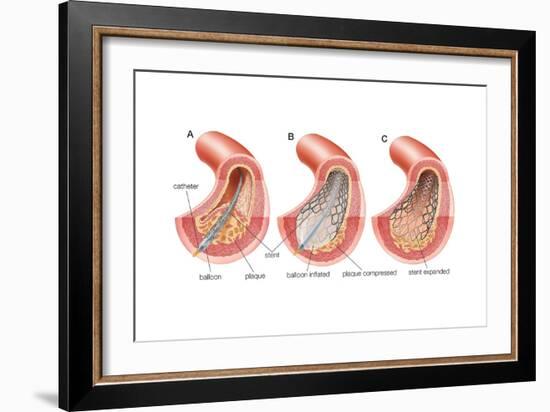 Balloon Angioplasty and Stent Insertion. Cardiovascular System, Health and Disease-Encyclopaedia Britannica-Framed Art Print