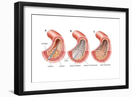 Balloon Angioplasty and Stent Insertion. Cardiovascular System, Health and Disease-Encyclopaedia Britannica-Framed Art Print