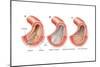 Balloon Angioplasty and Stent Insertion. Cardiovascular System, Health and Disease-Encyclopaedia Britannica-Mounted Art Print