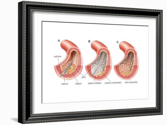 Balloon Angioplasty and Stent Insertion. Cardiovascular System, Health and Disease-Encyclopaedia Britannica-Framed Art Print