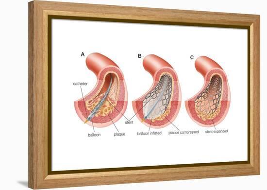 Balloon Angioplasty and Stent Insertion. Cardiovascular System, Health and Disease-Encyclopaedia Britannica-Framed Stretched Canvas