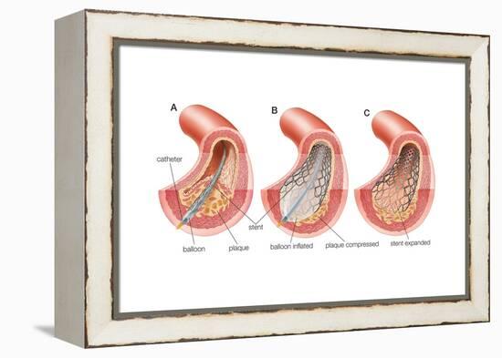 Balloon Angioplasty and Stent Insertion. Cardiovascular System, Health and Disease-Encyclopaedia Britannica-Framed Stretched Canvas