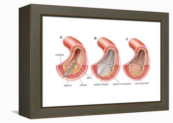 Balloon Angioplasty and Stent Insertion. Cardiovascular System, Health and Disease-Encyclopaedia Britannica-Framed Stretched Canvas
