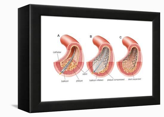 Balloon Angioplasty and Stent Insertion. Cardiovascular System, Health and Disease-Encyclopaedia Britannica-Framed Stretched Canvas