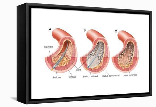 Balloon Angioplasty and Stent Insertion. Cardiovascular System, Health and Disease-Encyclopaedia Britannica-Framed Stretched Canvas