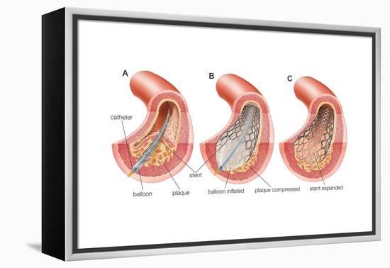 Balloon Angioplasty and Stent Insertion. Cardiovascular System, Health and Disease-Encyclopaedia Britannica-Framed Stretched Canvas