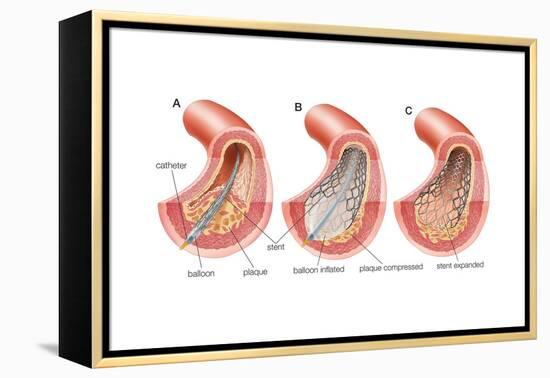 Balloon Angioplasty and Stent Insertion. Cardiovascular System, Health and Disease-Encyclopaedia Britannica-Framed Stretched Canvas