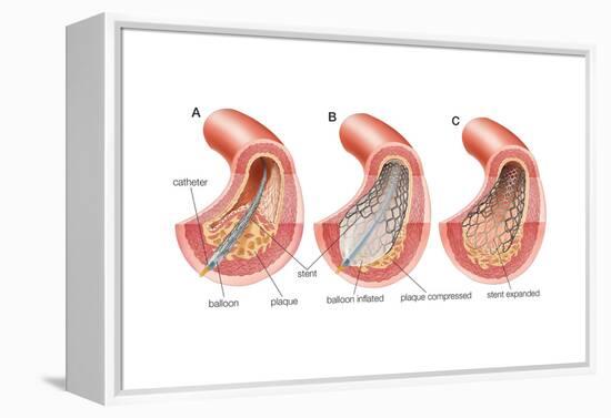 Balloon Angioplasty and Stent Insertion. Cardiovascular System, Health and Disease-Encyclopaedia Britannica-Framed Stretched Canvas