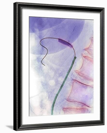 Balloon Angioplasty, X-ray-Du Cane Medical-Framed Photographic Print