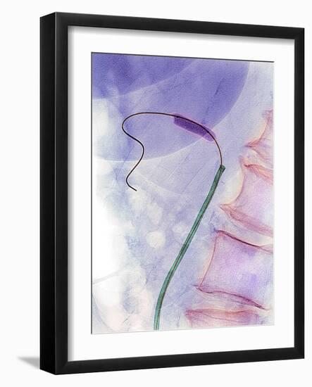 Balloon Angioplasty, X-ray-Du Cane Medical-Framed Photographic Print