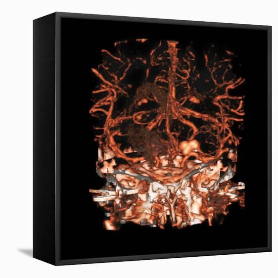 Berry Aneurysm, Angiogram-Du Cane Medical-Framed Premier Image Canvas
