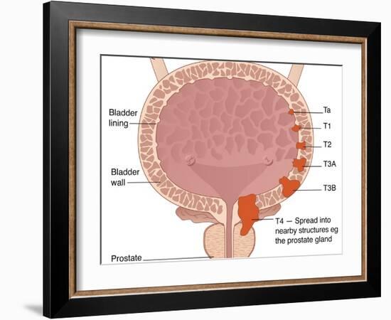 Bladder Cancer Stages, Artwork-Peter Gardiner-Framed Photographic Print