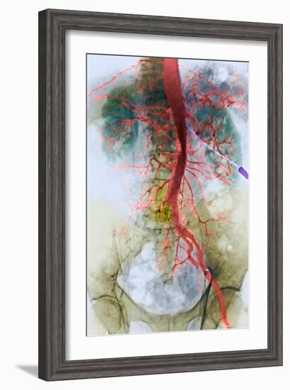 Blocked Artery, X-ray-null-Framed Photographic Print
