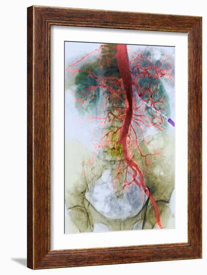 Blocked Artery, X-ray-null-Framed Photographic Print