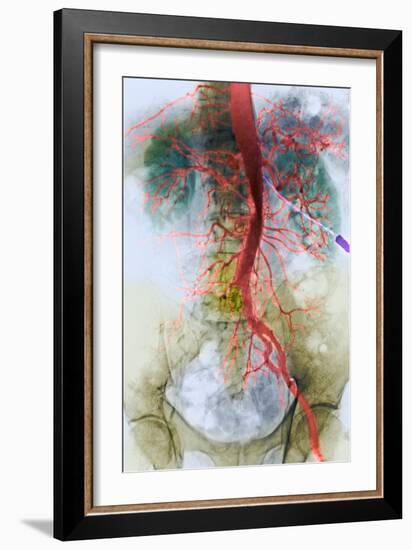 Blocked Artery, X-ray-null-Framed Photographic Print