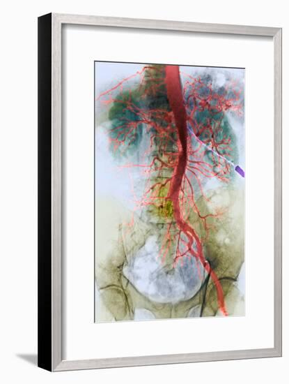 Blocked Artery, X-ray-null-Framed Photographic Print