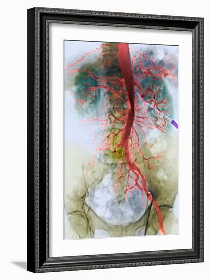 Blocked Artery, X-ray-null-Framed Photographic Print