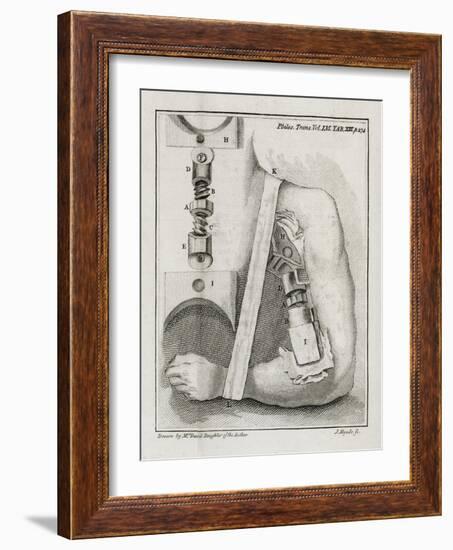 Bone-setting Mechanism, 18th Century-Middle Temple Library-Framed Photographic Print