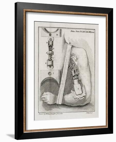 Bone-setting Mechanism, 18th Century-Middle Temple Library-Framed Photographic Print