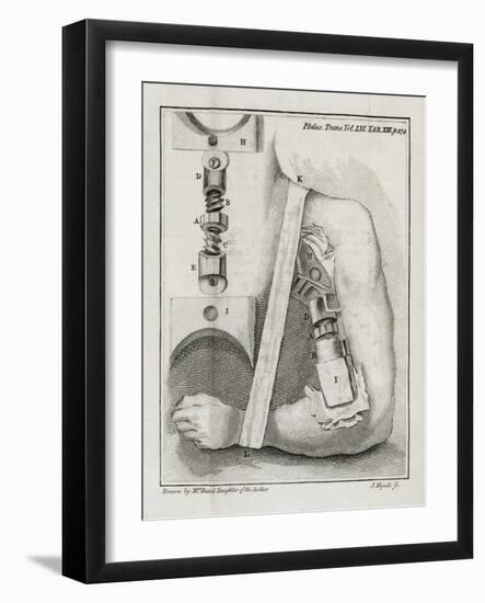 Bone-setting Mechanism, 18th Century-Middle Temple Library-Framed Photographic Print