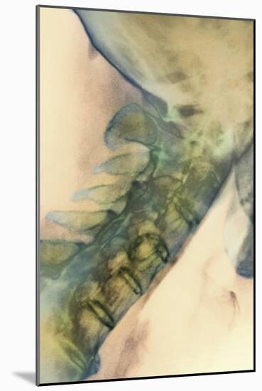 Bony Spurs In Neck, X-ray-null-Mounted Photographic Print