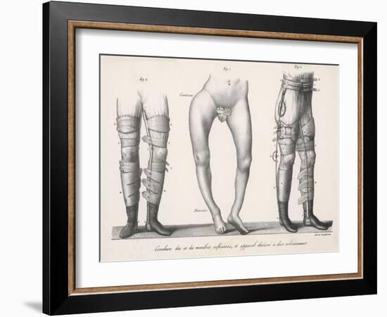 Bow Legs and Their Treatment with Apparatus Intended to Straighten Them-Langlume-Framed Art Print