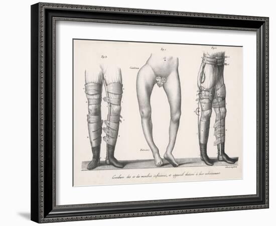 Bow Legs and Their Treatment with Apparatus Intended to Straighten Them-Langlume-Framed Art Print