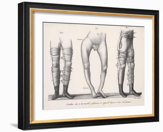 Bow Legs and Their Treatment with Apparatus Intended to Straighten Them-Langlume-Framed Art Print
