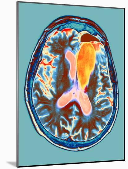 Brain Cancer Treatment, MRI Scan-Du Cane Medical-Mounted Photographic Print