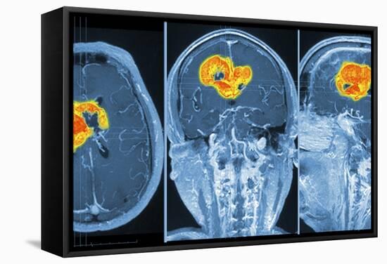 Brain Tumour, MRI Scan-PASIEKA-Framed Premier Image Canvas