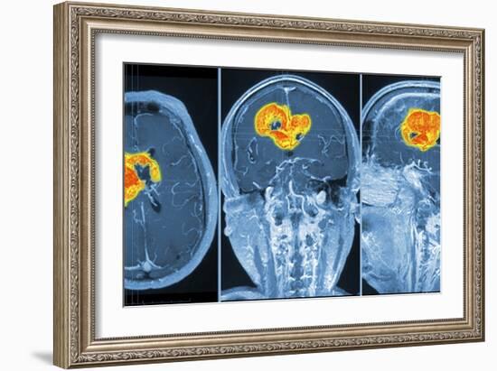 Brain Tumour, MRI Scan-PASIEKA-Framed Photographic Print