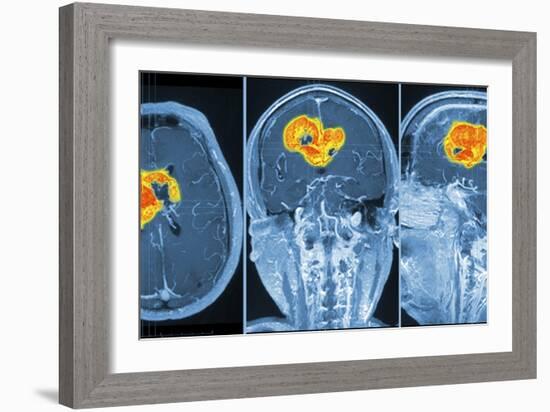 Brain Tumour, MRI Scan-PASIEKA-Framed Photographic Print