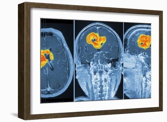 Brain Tumour, MRI Scan-PASIEKA-Framed Photographic Print