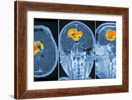 Brain Tumour, MRI Scan-PASIEKA-Framed Photographic Print