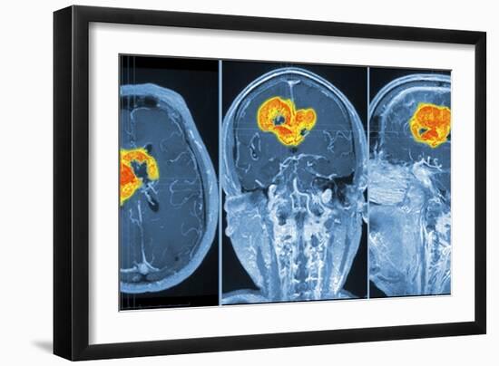 Brain Tumour, MRI Scan-PASIEKA-Framed Photographic Print