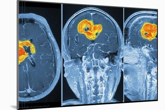 Brain Tumour, MRI Scan-PASIEKA-Mounted Photographic Print