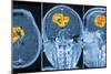 Brain Tumour, MRI Scan-PASIEKA-Mounted Photographic Print